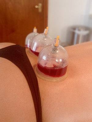 wet cupping 2